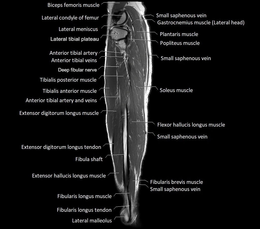 Lower leg sagittal anatomy 3T MRI image 11.webp